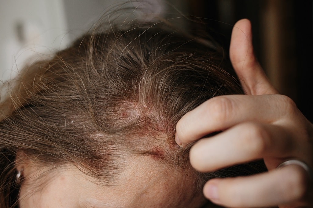 Head Lice Symptoms, Causes & Diagnosis LiceDoctors LiceDoctors